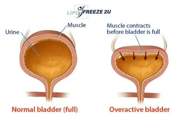 diagram of overactive bladder treatment Bradford