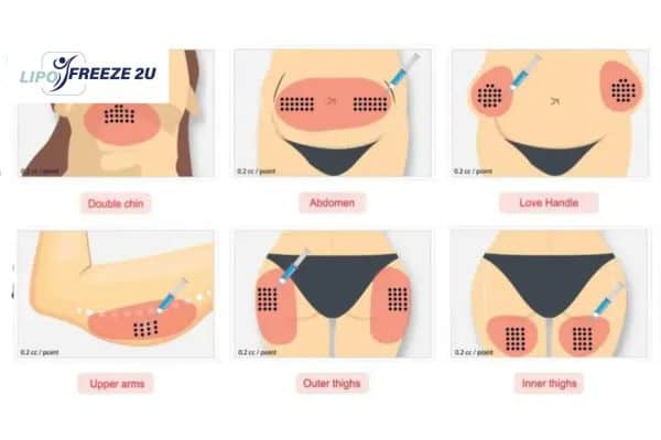 Benefits of Choosing Aqualyx for Fat Reduction Bradford
