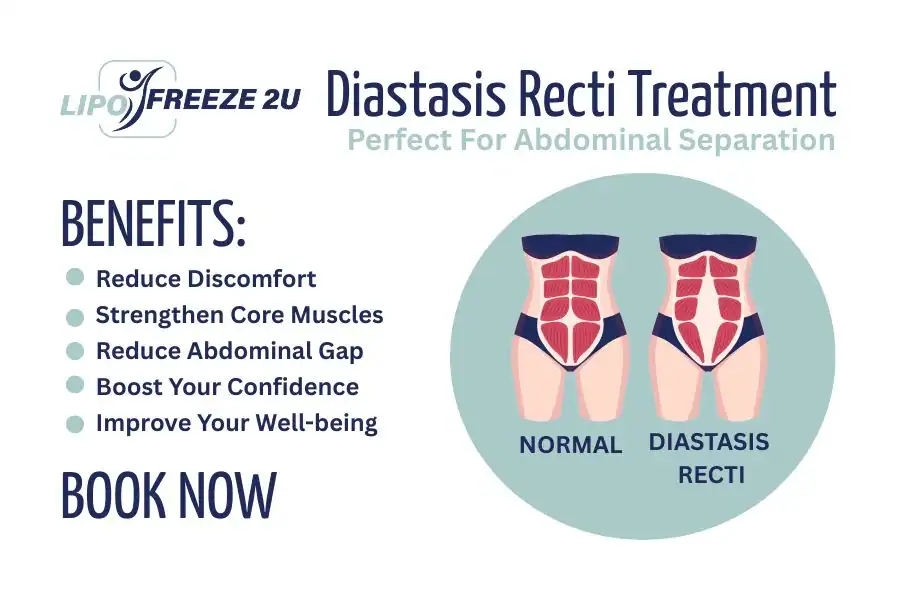 How Long Will It Take to See Improvements in Diastasis Recti Bradford