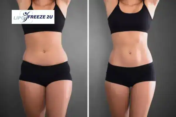 How Can LIPO FREEZE 2U Support Your Post-Pregnancy Body Recovery Bradford?