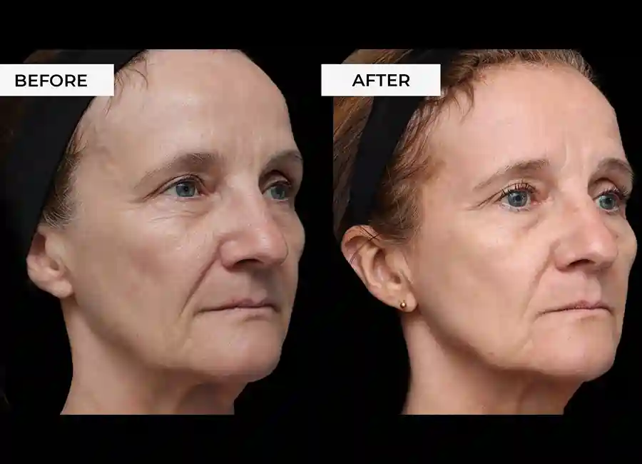 How Many RF Microneedling Sessions Will You Need to See a Difference Bradford?