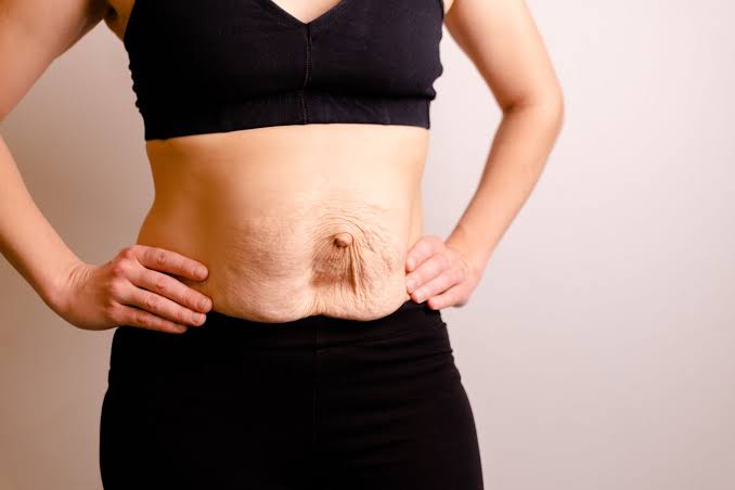 Is Surgery Really the Only Way to Repair Diastasis Recti Bradford?