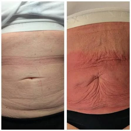 How Does RF Microneedling Improve Crepey, Thin and Uneven Skin Texture Bradford?