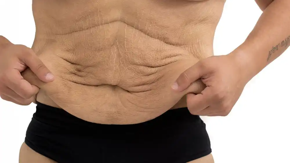 Why Does Weight Loss Medication Leave Some People With Loose or Sagging Skin Bradford?